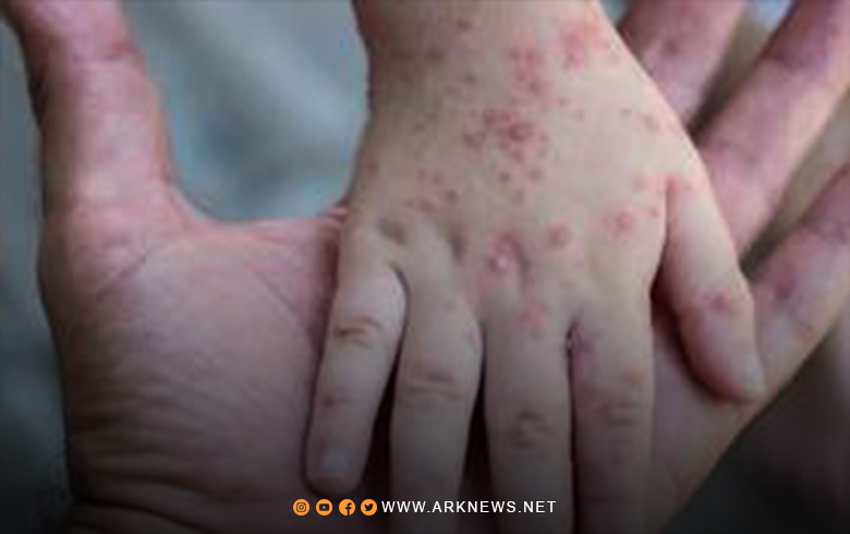 سوريا خالية من مرض جدري القردة والقطاع الصحي اتخذ اجراءات الوقاية مسبقا