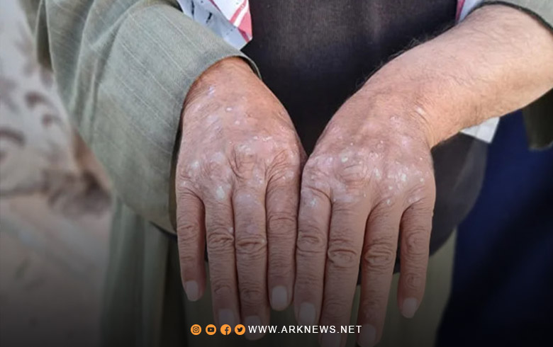 ارتفاع نسبة تسجيل الأمراض الجلدية والتنفسية في مخيمات شمال غربي سوريا