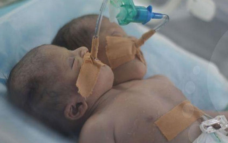 ولادة نادرة في مصر.. طفل برأسين وقلب واحد