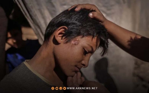 انتشار الأمراض الجلدية في مخيمات النازحين شمال غربي سوريا انتشار الأمراض الجلدية في مخيمات النازحين شمال غربي سوريا