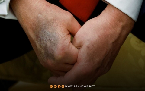 كدمة زرقاء داكنة على يد دونالد ترامب تثير المخاوف حول وضعه الصحي
