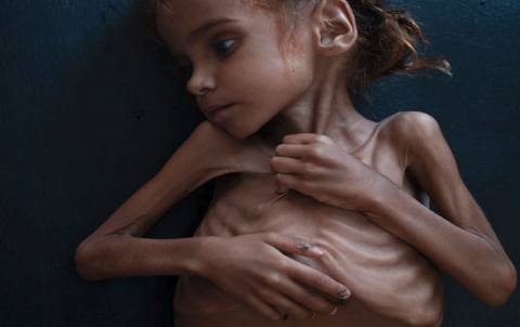 رحيل الطفلة التي فتحت عيون العالم على مأساة اليمن رحيل الطفلة التي فتحت عيون العالم على مأساة اليمن