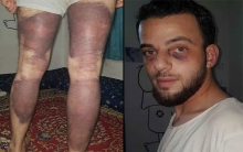 عفرين .. مسلحو السلطان مراد يعتدون بالضرب على ناشط مدني
